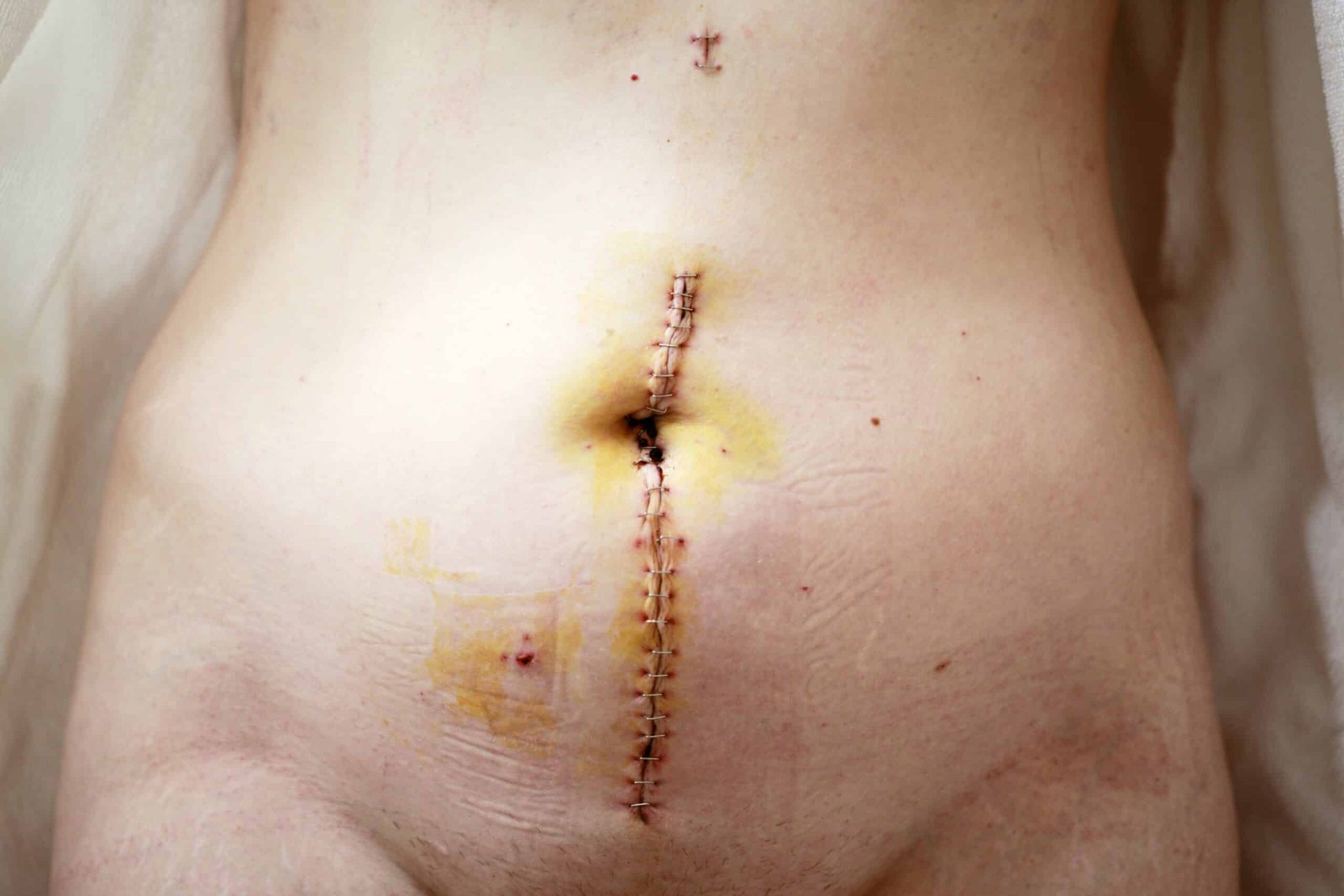 le cancer de l'estomac est une maladie grave qui se forme dans les tissus de l'estomac. découvrez ses symptômes, ses traitements et ses facteurs de risque.